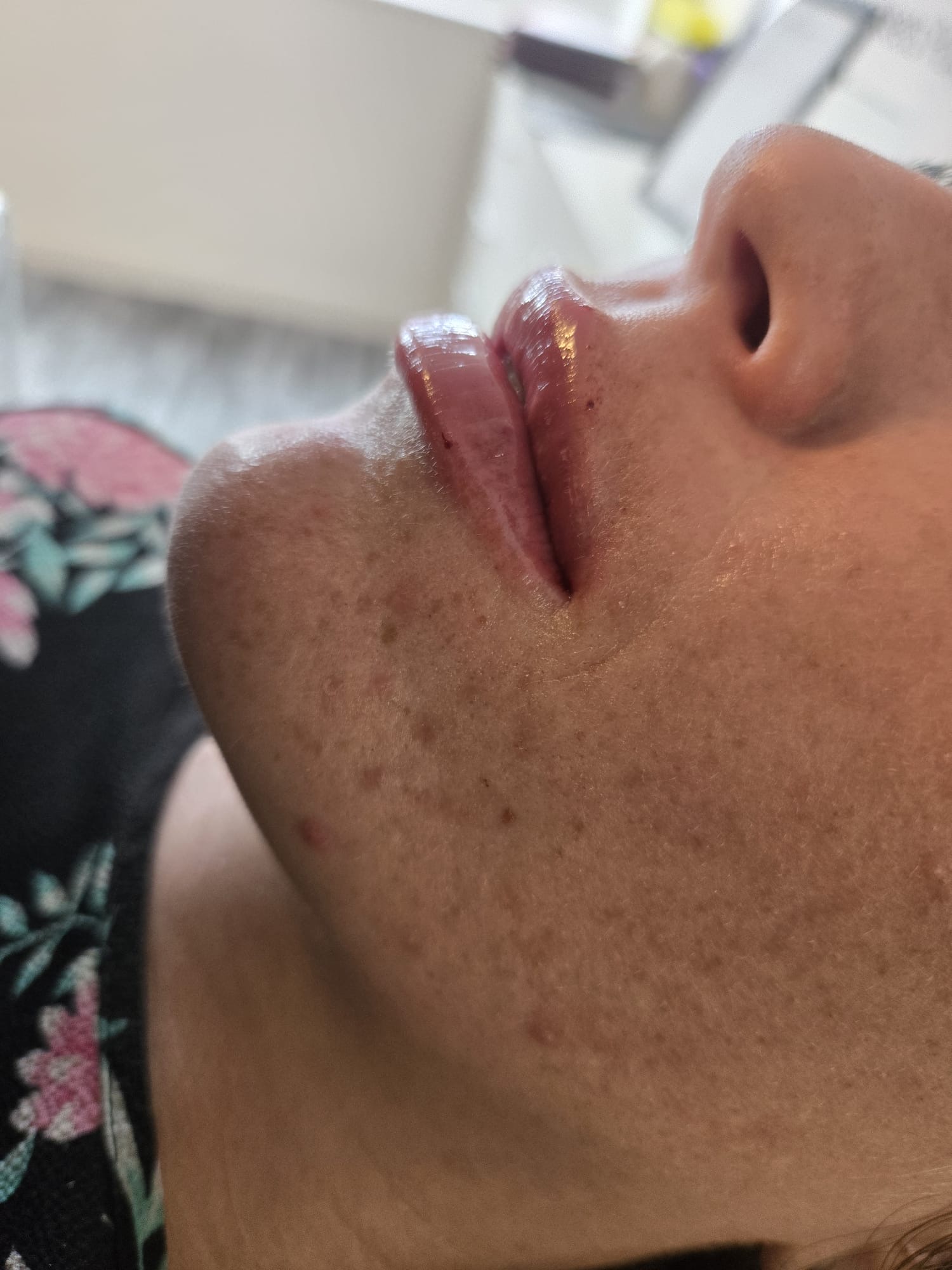 Lips immediately after a lip filler treatment