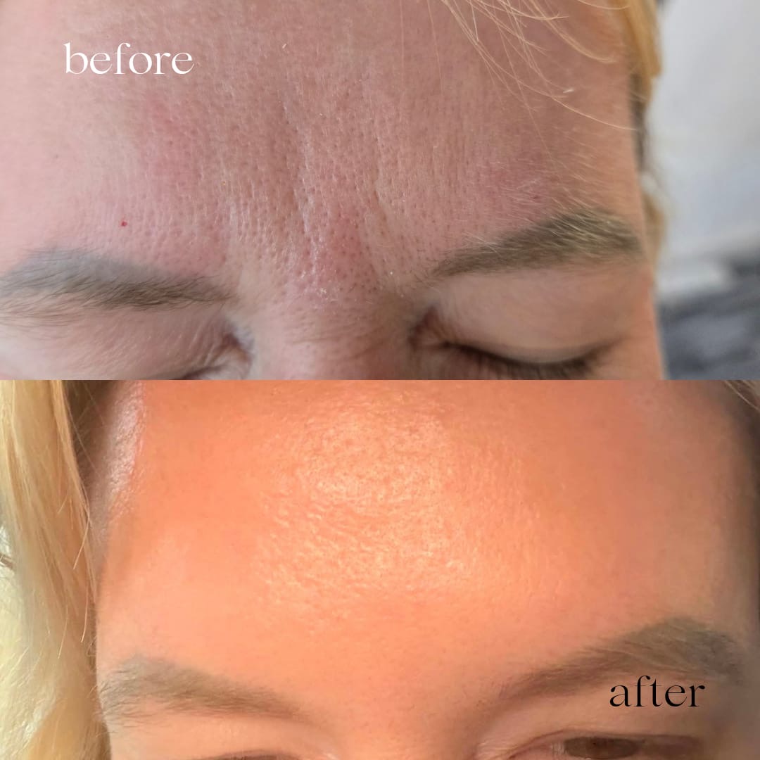 Before and after anti-wrinkle treatment, smoother forehead