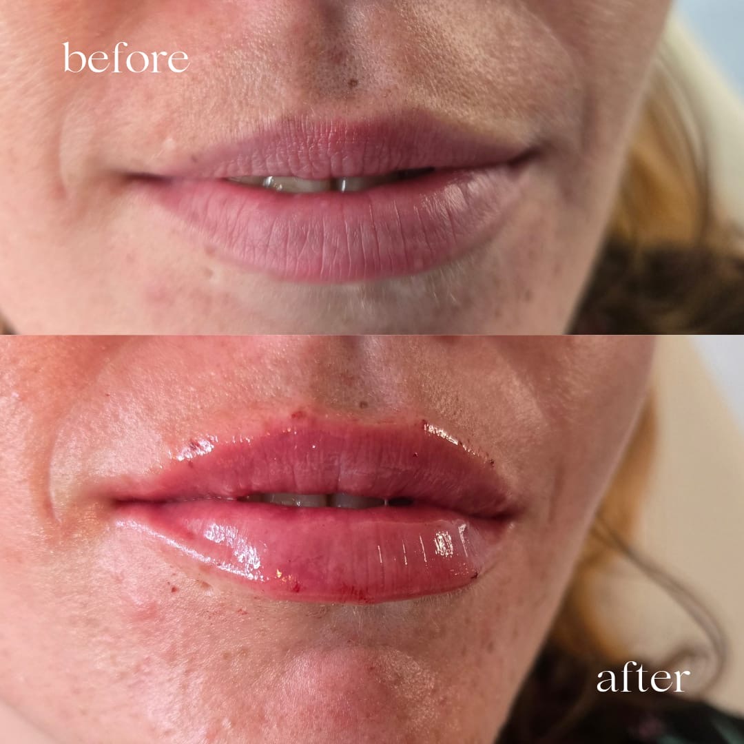 Before and after lip filler, front view
