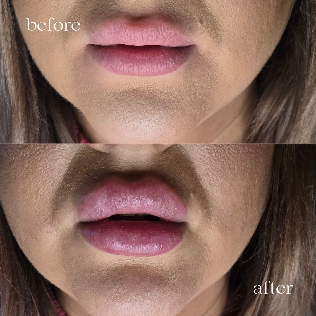 Before and after lip filler, fuller lips