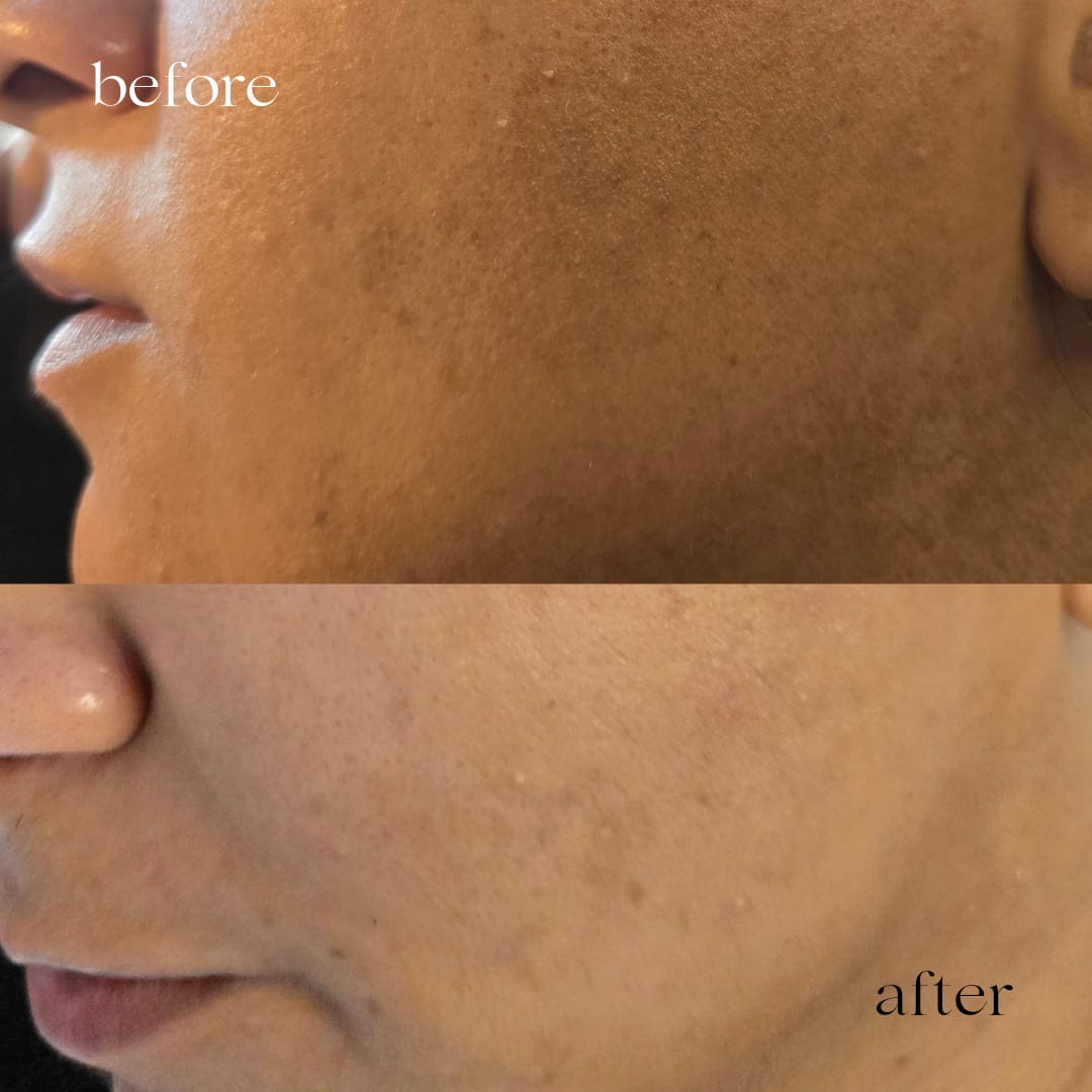 Before and after skin treatment, more even tone