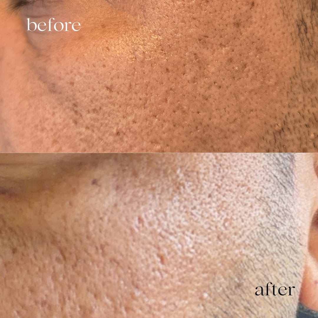 Before and after skin treatment on a male client, refined pores